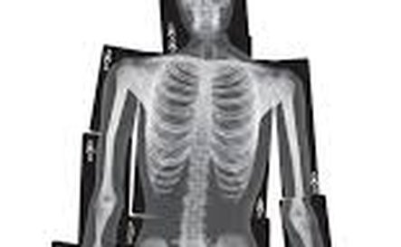 11164 - Human X-Rays